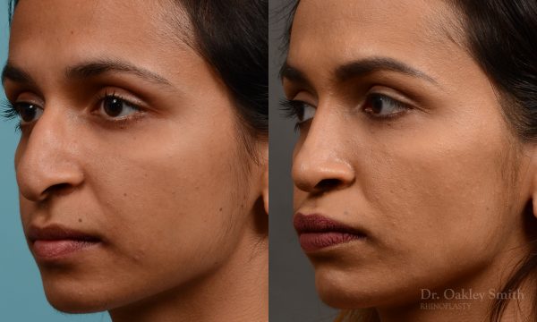 rhinoplasty Nothing demonstrates the skillful craftsmanship that Dr. Oakley Smith accomplishes during his surgeries than a collection of before and after case studies. As one of a hand full of surgeons in North America who limits his practice to only Rhinoplasty surgery, it is obvious that he has mastered his art. There is no question why he is one of the busiest cosmetic nose job surgeons in the country.
