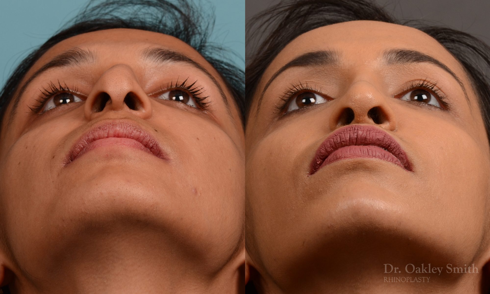 rhinoplasty Nothing demonstrates the skillful craftsmanship that Dr. Oakley Smith accomplishes during his surgeries than a collection of before and after case studies. As one of a hand full of surgeons in North America who limits his practice to only Rhinoplasty surgery, it is obvious that he has mastered his art. There is no question why he is one of the busiest cosmetic nose job surgeons in the country.