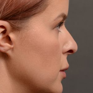 Rhinoplasty - Rhinoplasty Before and After Case 361