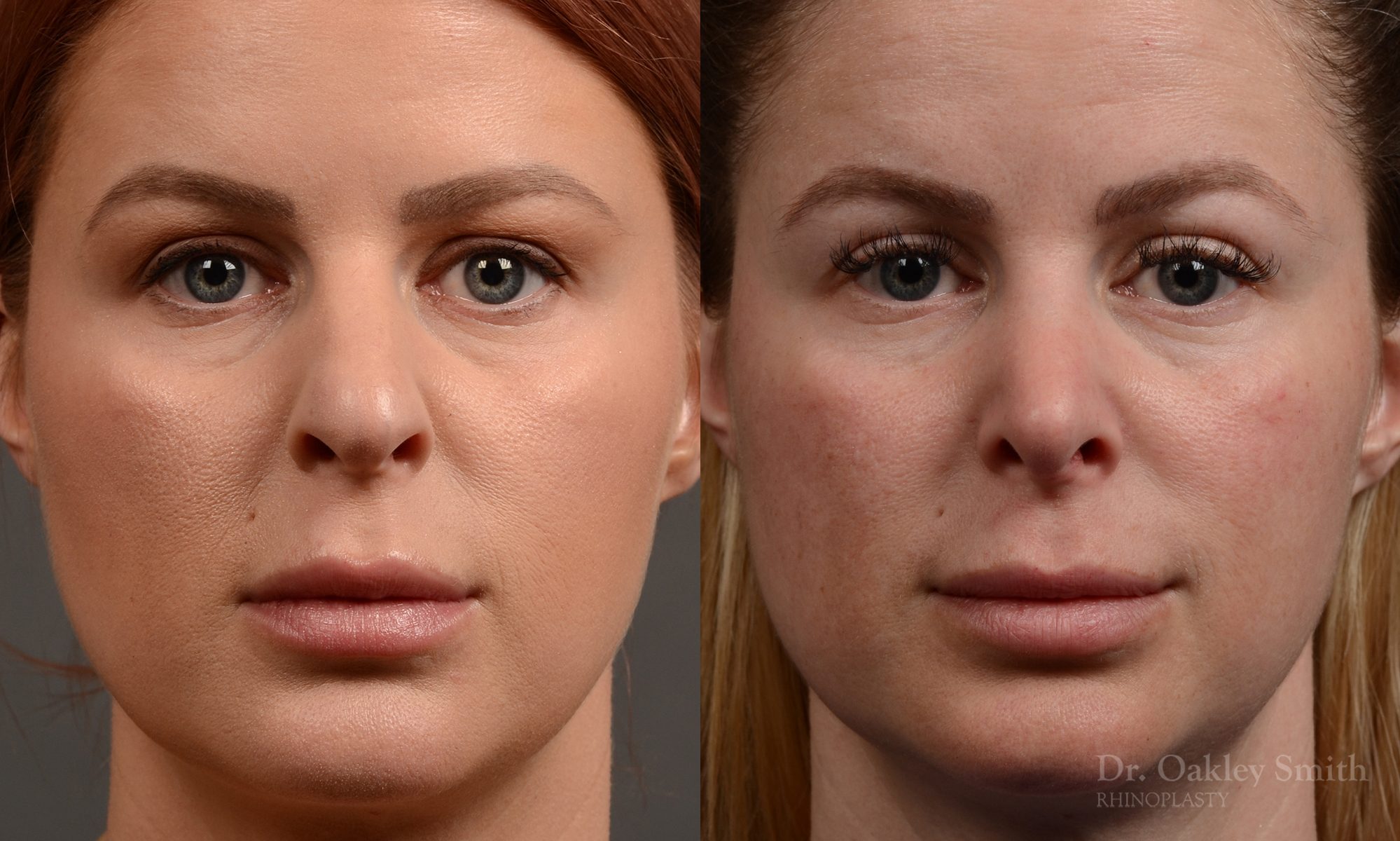 Rhinoplasty - Rhinoplasty Before and After Case 361