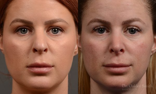Rhinoplasty - Rhinoplasty Before and After Case 361
