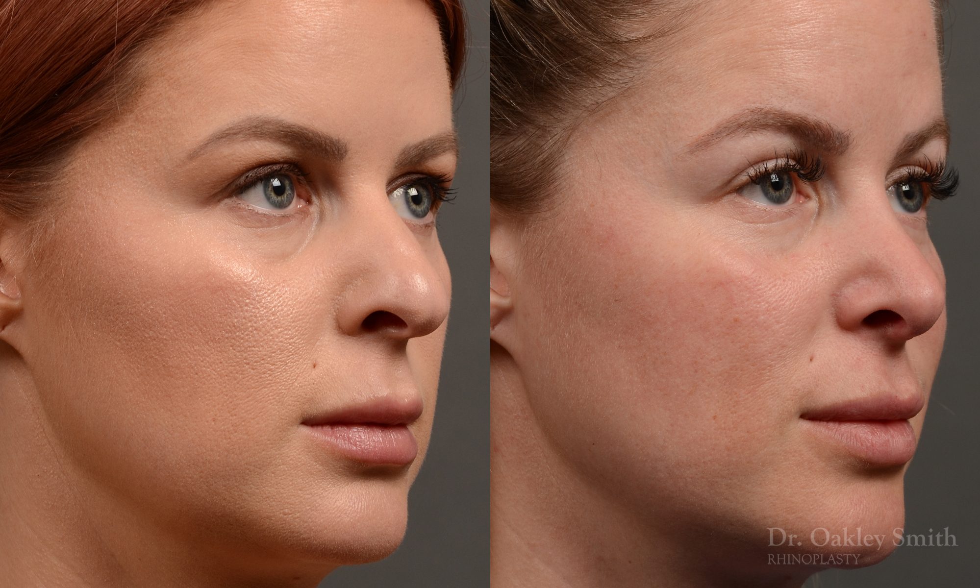 Rhinoplasty - Rhinoplasty Before and After Case 361