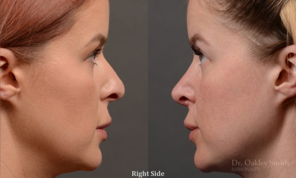 Rhinoplasty - Rhinoplasty Before and After Case 361