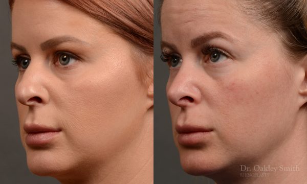 Rhinoplasty - Rhinoplasty Before and After Case 361