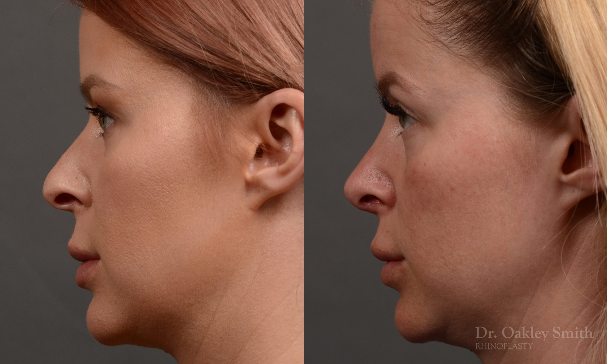 Rhinoplasty - Rhinoplasty Before and After Case 361