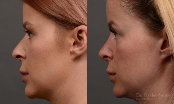 Rhinoplasty - Rhinoplasty Before and After Case 361