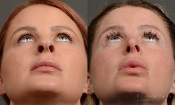 Rhinoplasty - Rhinoplasty Before and After Case 361