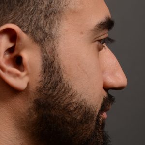 male hump reduction rhinoplasty