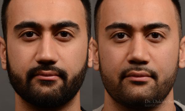 rhinoplasty Nothing demonstrates the skillful craftsmanship that Dr. Oakley Smith accomplishes during his surgeries than a collection of before and after case studies. As one of a hand full of surgeons in North America who limits his practice to only Rhinoplasty surgery, it is obvious that he has mastered his art. There is no question why he is one of the busiest cosmetic nose job surgeons in the country.