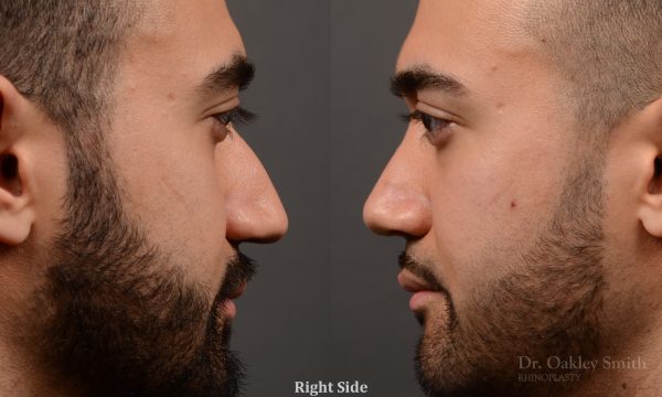 rhinoplasty Nothing demonstrates the skillful craftsmanship that Dr. Oakley Smith accomplishes during his surgeries than a collection of before and after case studies. As one of a hand full of surgeons in North America who limits his practice to only Rhinoplasty surgery, it is obvious that he has mastered his art. There is no question why he is one of the busiest cosmetic nose job surgeons in the country.