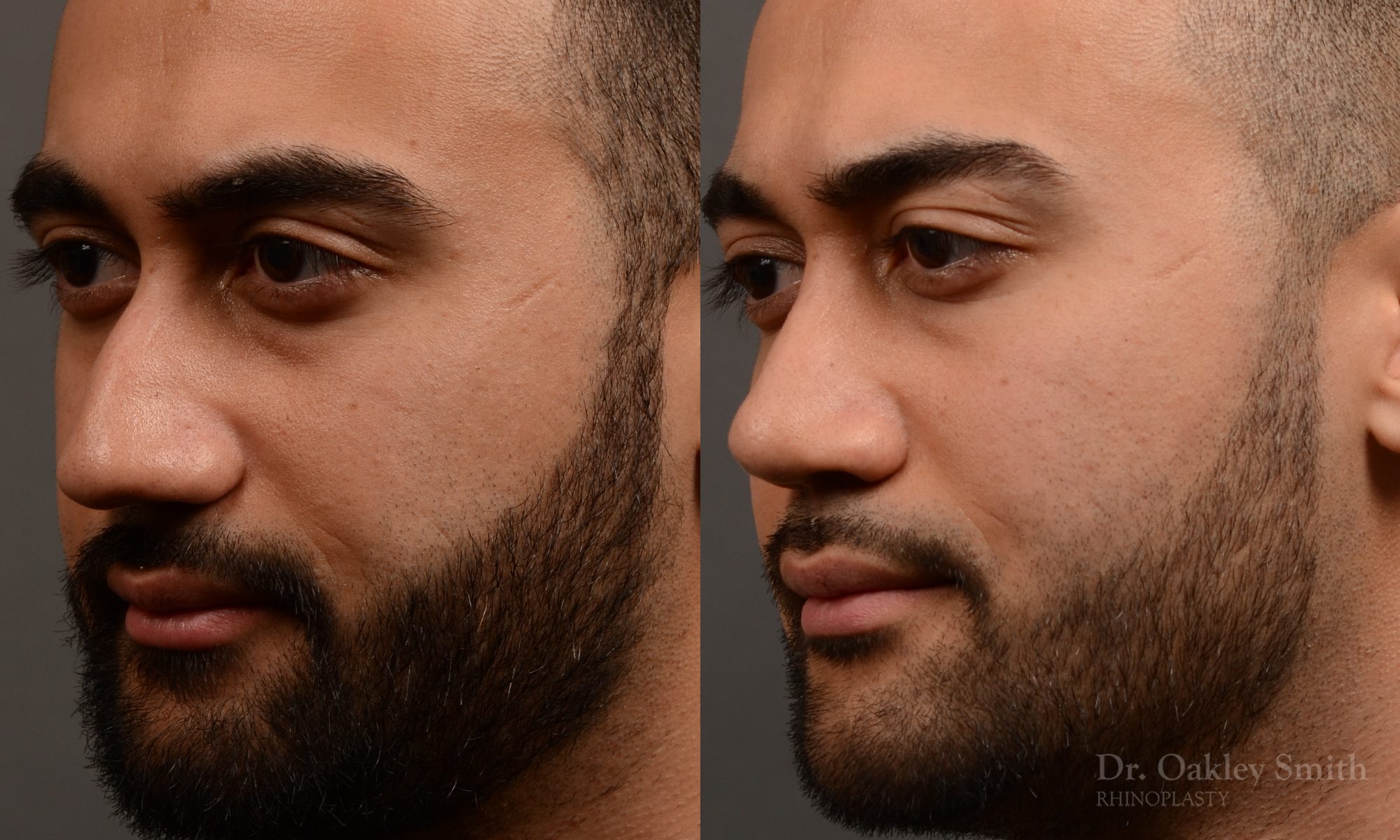 rhinoplasty Nothing demonstrates the skillful craftsmanship that Dr. Oakley Smith accomplishes during his surgeries than a collection of before and after case studies. As one of a hand full of surgeons in North America who limits his practice to only Rhinoplasty surgery, it is obvious that he has mastered his art. There is no question why he is one of the busiest cosmetic nose job surgeons in the country.