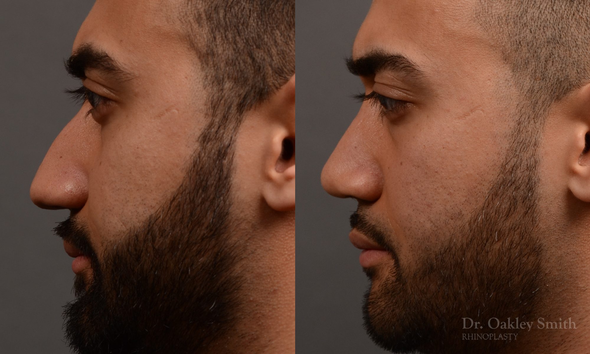 rhinoplasty Nothing demonstrates the skillful craftsmanship that Dr. Oakley Smith accomplishes during his surgeries than a collection of before and after case studies. As one of a hand full of surgeons in North America who limits his practice to only Rhinoplasty surgery, it is obvious that he has mastered his art. There is no question why he is one of the busiest cosmetic nose job surgeons in the country.