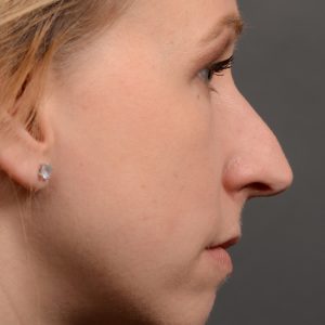 rhino hump big nose