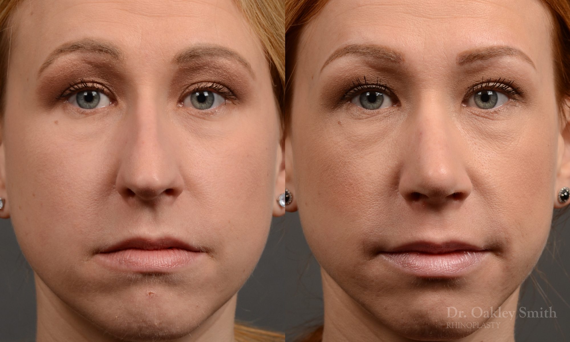 basal view rhinoplasty nose job