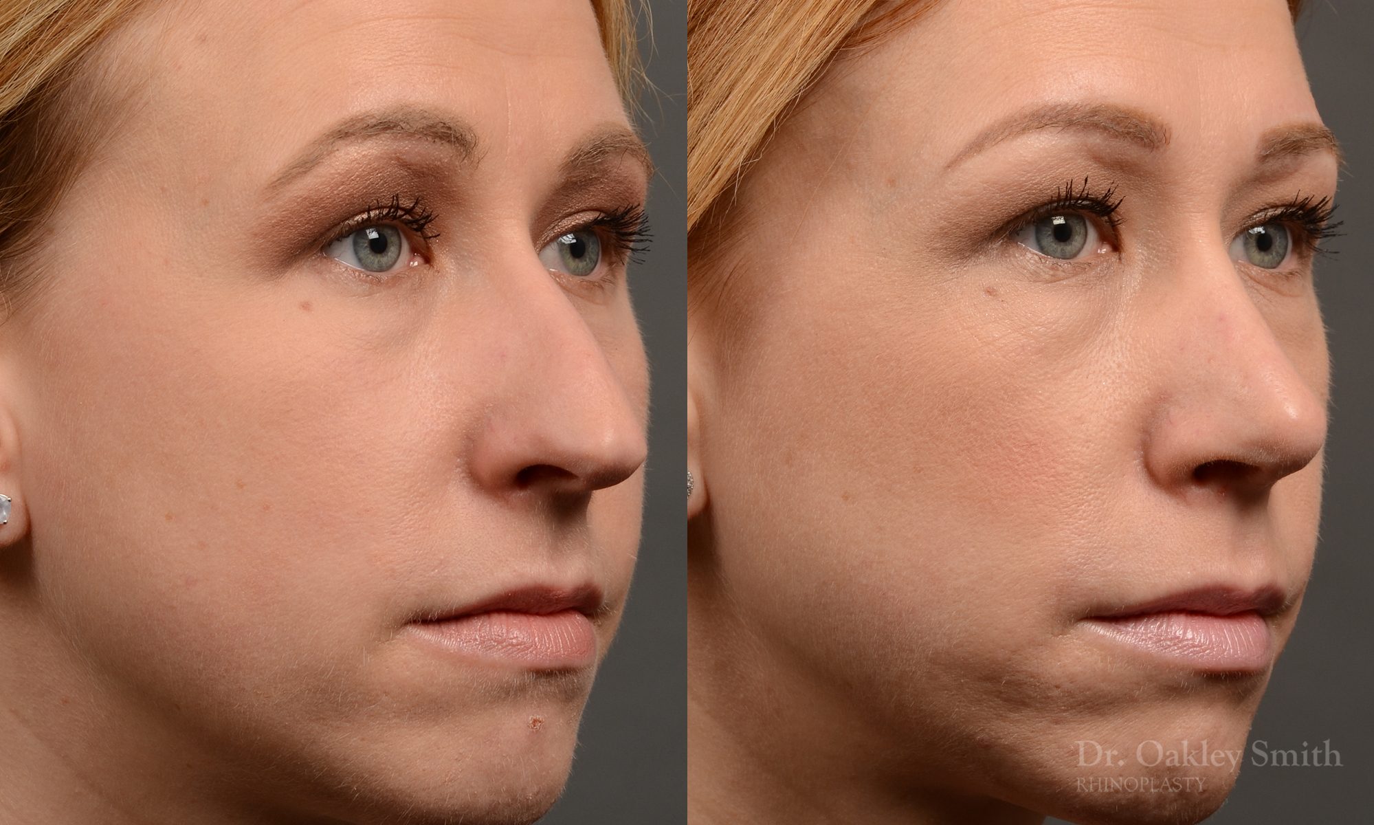 basal view rhinoplasty nose job