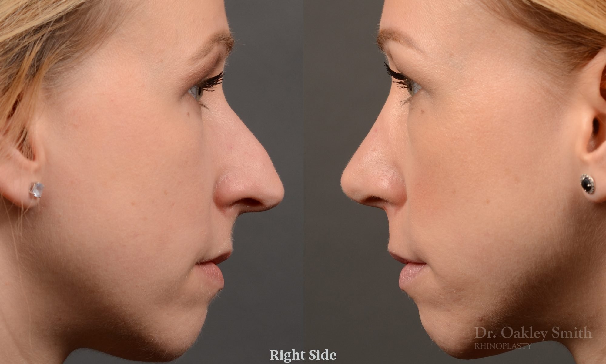 basal view rhinoplasty nose job right profile