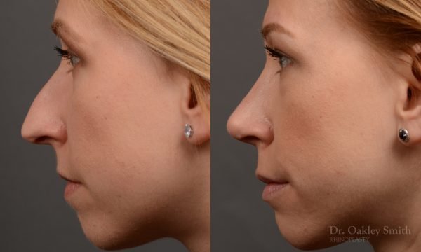 left profile view rhinoplasty nose job