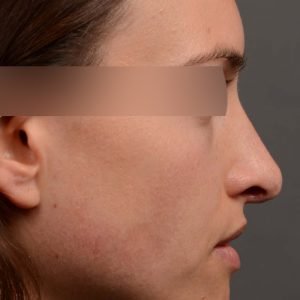 rhinoplasty Nothing demonstrates the skillful craftsmanship that Dr. Oakley Smith accomplishes during his surgeries than a collection of before and after case studies. As one of a hand full of surgeons in North America who limits his practice to only Rhinoplasty surgery, it is obvious that he has mastered his art. There is no question why he is one of the busiest cosmetic nose job surgeons in the country.