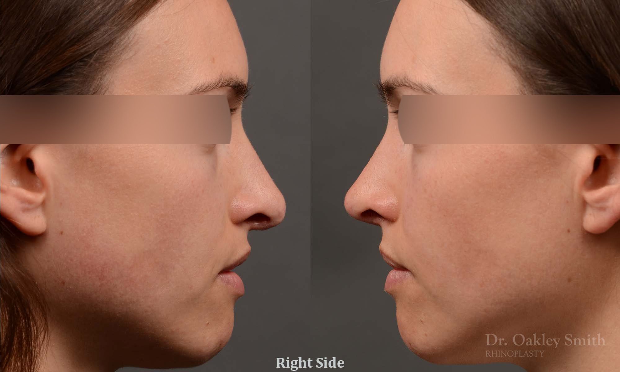 rhinoplasty Nothing demonstrates the skillful craftsmanship that Dr. Oakley Smith accomplishes during his surgeries than a collection of before and after case studies. As one of a hand full of surgeons in North America who limits his practice to only Rhinoplasty surgery, it is obvious that he has mastered his art. There is no question why he is one of the busiest cosmetic nose job surgeons in the country.
