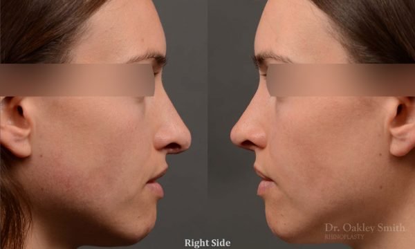 rhinoplasty Nothing demonstrates the skillful craftsmanship that Dr. Oakley Smith accomplishes during his surgeries than a collection of before and after case studies. As one of a hand full of surgeons in North America who limits his practice to only Rhinoplasty surgery, it is obvious that he has mastered his art. There is no question why he is one of the busiest cosmetic nose job surgeons in the country.
