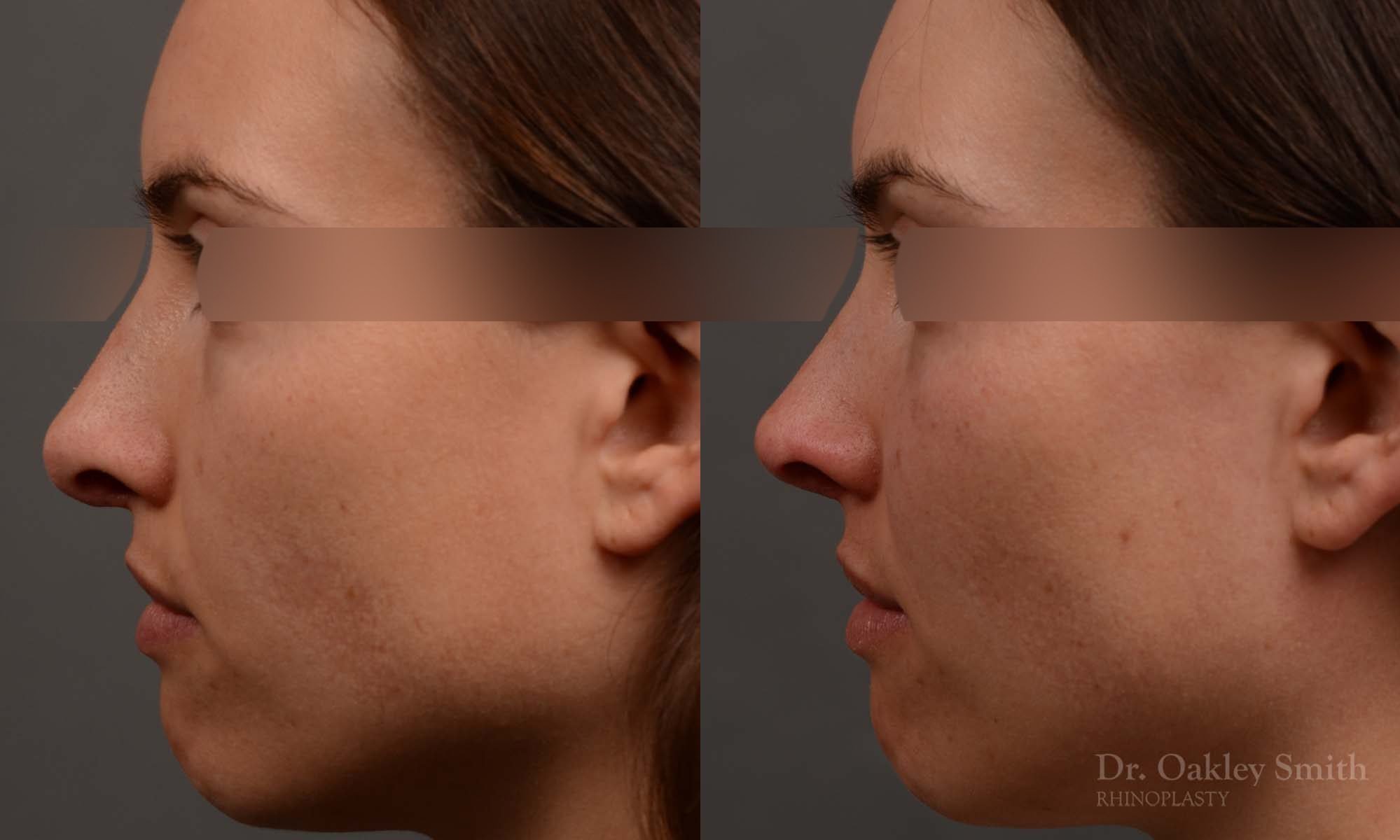 rhinoplasty Nothing demonstrates the skillful craftsmanship that Dr. Oakley Smith accomplishes during his surgeries than a collection of before and after case studies. As one of a hand full of surgeons in North America who limits his practice to only Rhinoplasty surgery, it is obvious that he has mastered his art. There is no question why he is one of the busiest cosmetic nose job surgeons in the country.