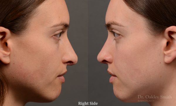 female nose rhinoplasty reduction