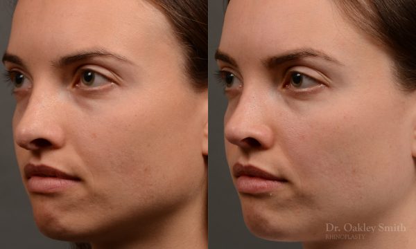 female nose rhinoplasty reduction