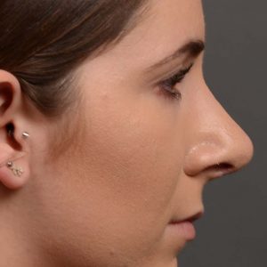 female nose reduction rhinoplasty that reduced the overall size of this womans nose