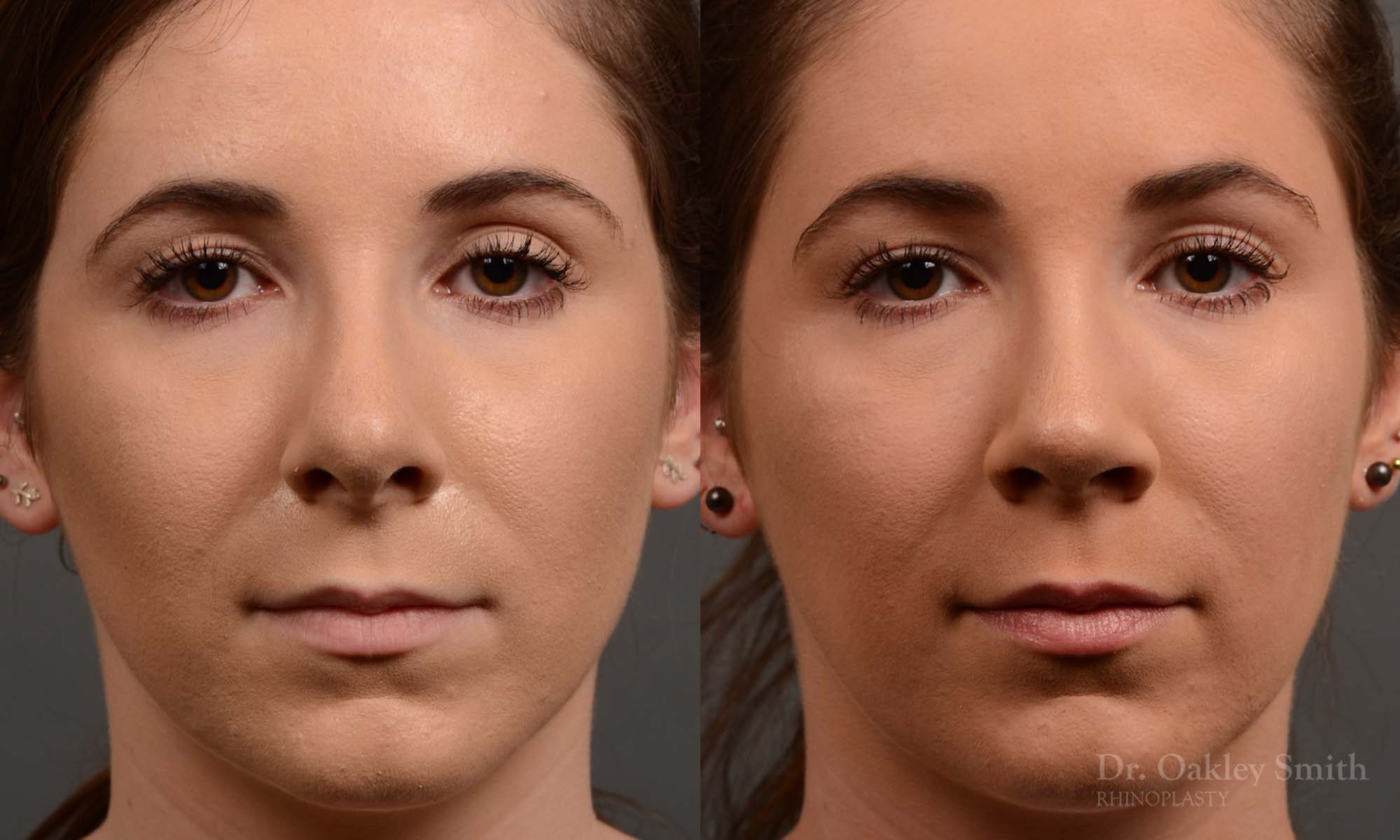 female nose reduction rhinoplasty that reduced the overall size of this womans nose