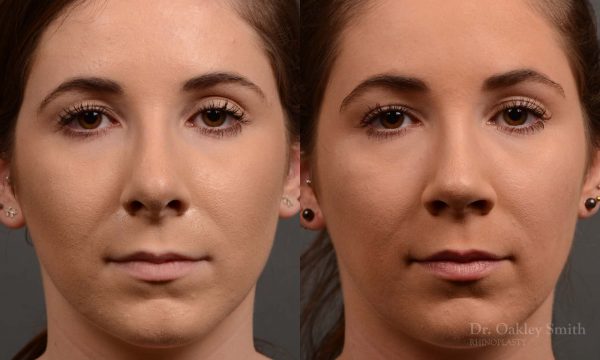 female nose reduction rhinoplasty that reduced the overall size of this womans nose