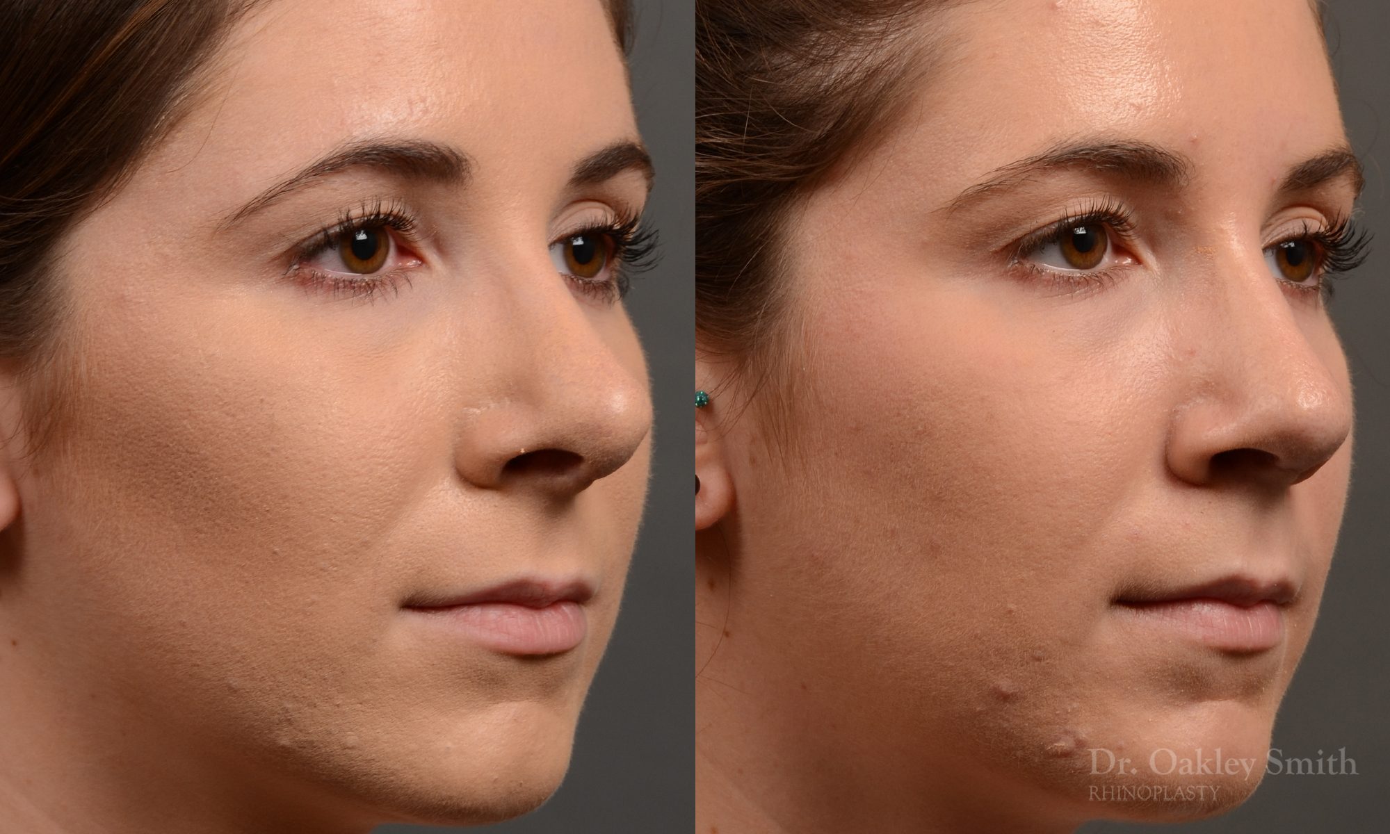 female nose reduction rhinoplasty that reduced the overall size of this womans nose