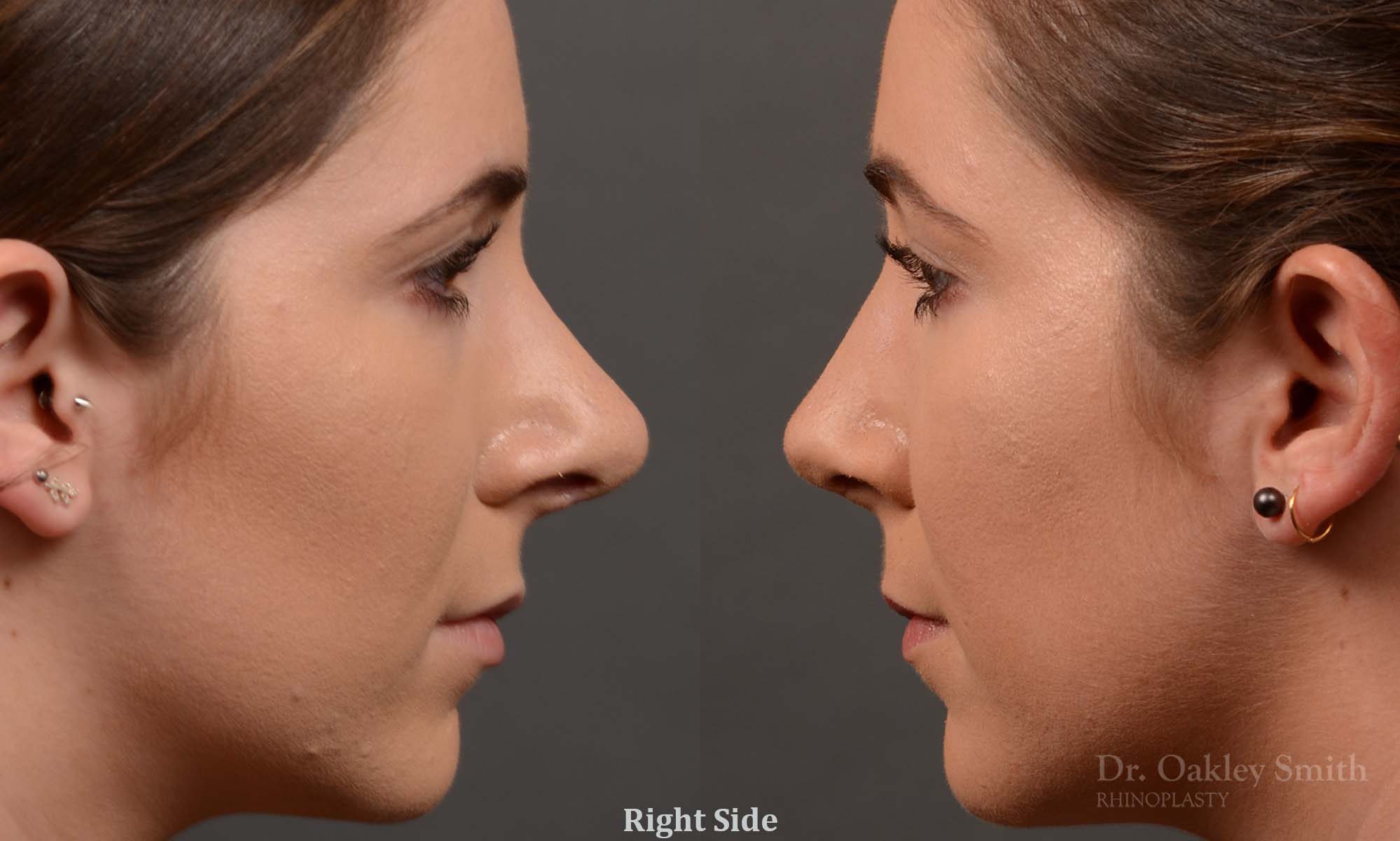 female nose reduction rhinoplasty that reduced the overall size of this womans nose