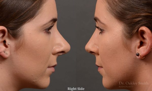female nose reduction rhinoplasty that reduced the overall size of this womans nose