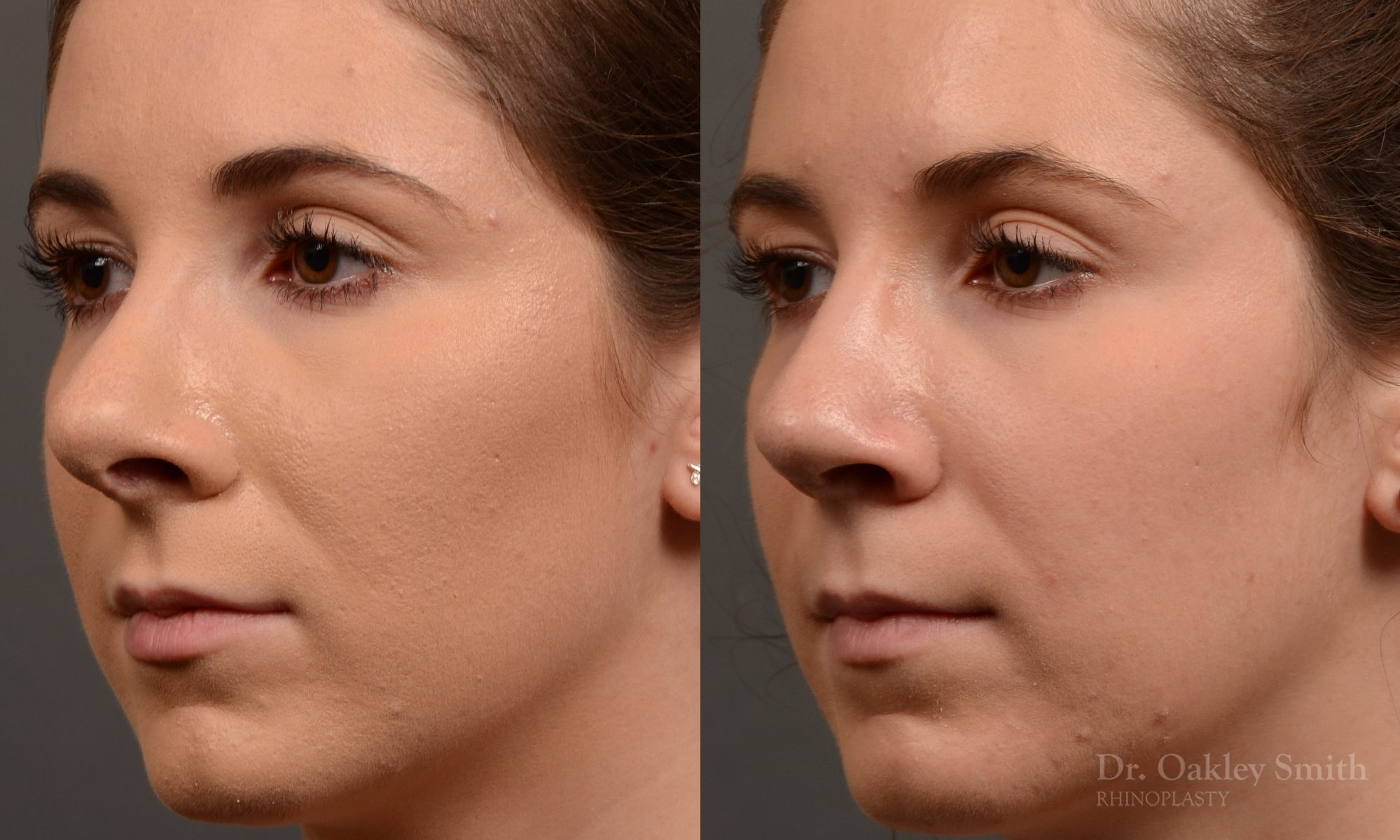 Rhinoplasty - Rhinoplasty Before and After Case 366