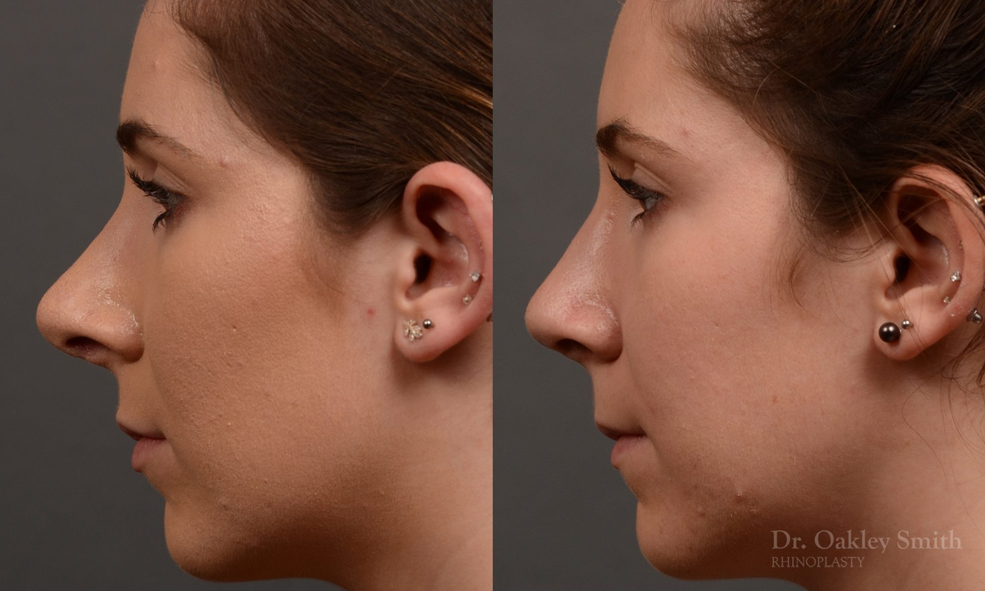 female nose reduction rhinoplasty that reduced the overall size of this womans nose