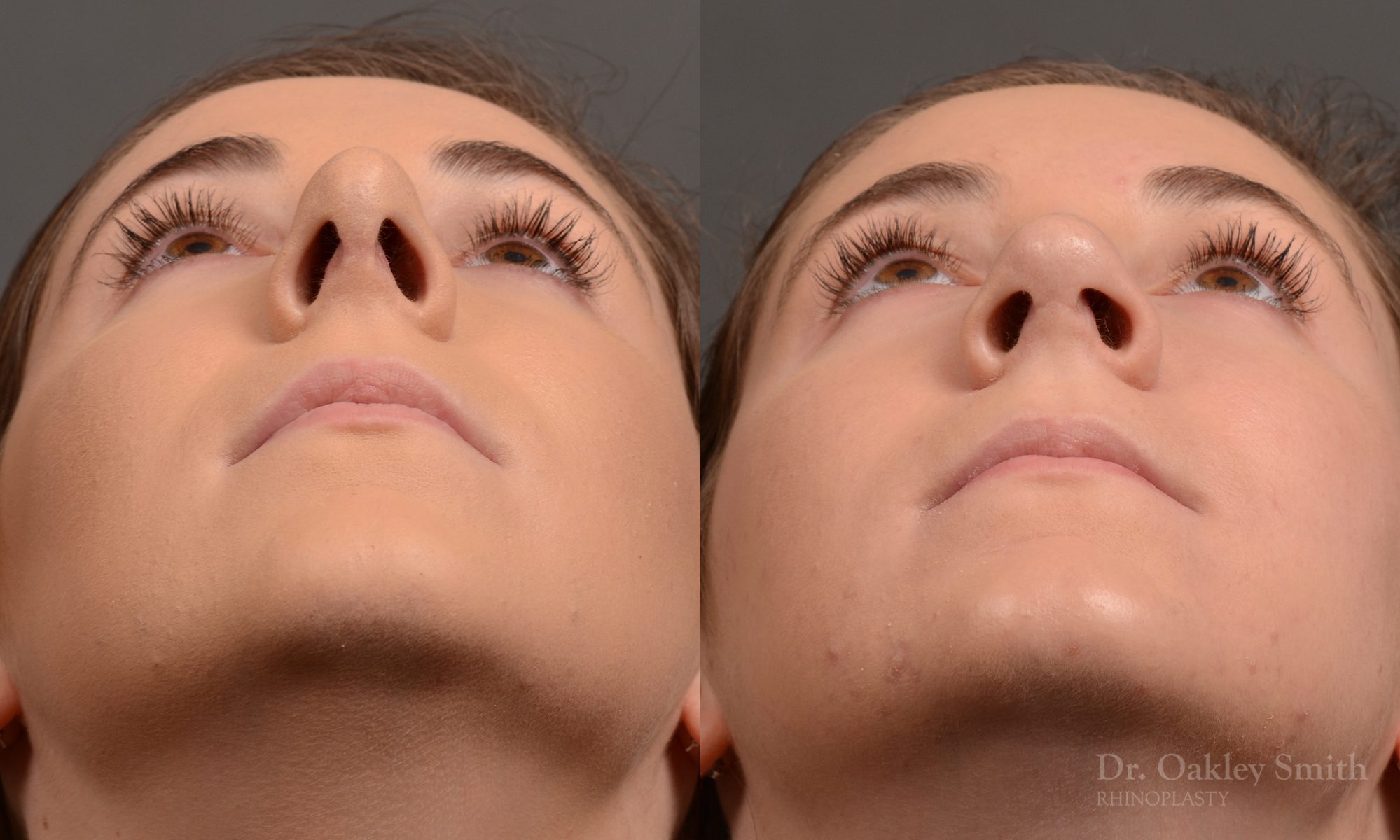 Rhinoplasty - Rhinoplasty Before and After Case 366