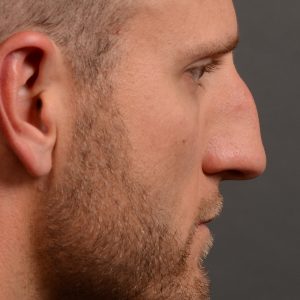 Nothing demonstrates the skillful craftsmanship that Dr. Oakley Smith accomplishes during his surgeries than a collection of before and after case studies. As one of a hand full of surgeons in North America who limits his practice to only Rhinoplasty surgery, it is obvious that he has mastered his art. There is no question why he is one of the busiest cosmetic nose job surgeons in the country.