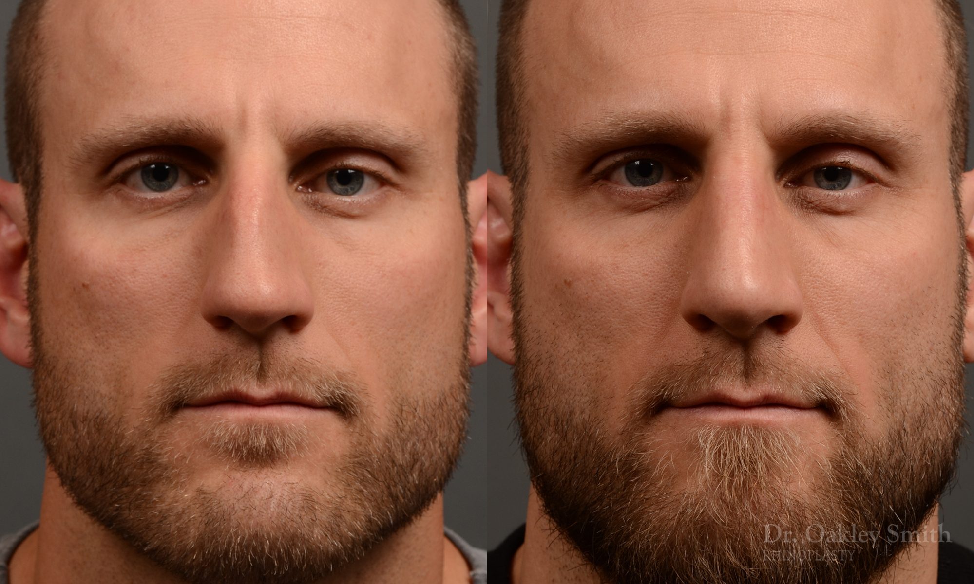 rhinoplasty Nothing demonstrates the skillful craftsmanship that Dr. Oakley Smith accomplishes during his surgeries than a collection of before and after case studies. As one of a hand full of surgeons in North America who limits his practice to only Rhinoplasty surgery, it is obvious that he has mastered his art. There is no question why he is one of the busiest cosmetic nose job surgeons in the country.