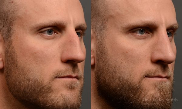 rhinoplasty Nothing demonstrates the skillful craftsmanship that Dr. Oakley Smith accomplishes during his surgeries than a collection of before and after case studies. As one of a hand full of surgeons in North America who limits his practice to only Rhinoplasty surgery, it is obvious that he has mastered his art. There is no question why he is one of the busiest cosmetic nose job surgeons in the country.