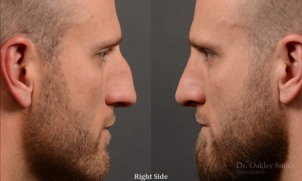 rhinoplasty Nothing demonstrates the skillful craftsmanship that Dr. Oakley Smith accomplishes during his surgeries than a collection of before and after case studies. As one of a hand full of surgeons in North America who limits his practice to only Rhinoplasty surgery, it is obvious that he has mastered his art. There is no question why he is one of the busiest cosmetic nose job surgeons in the country.
