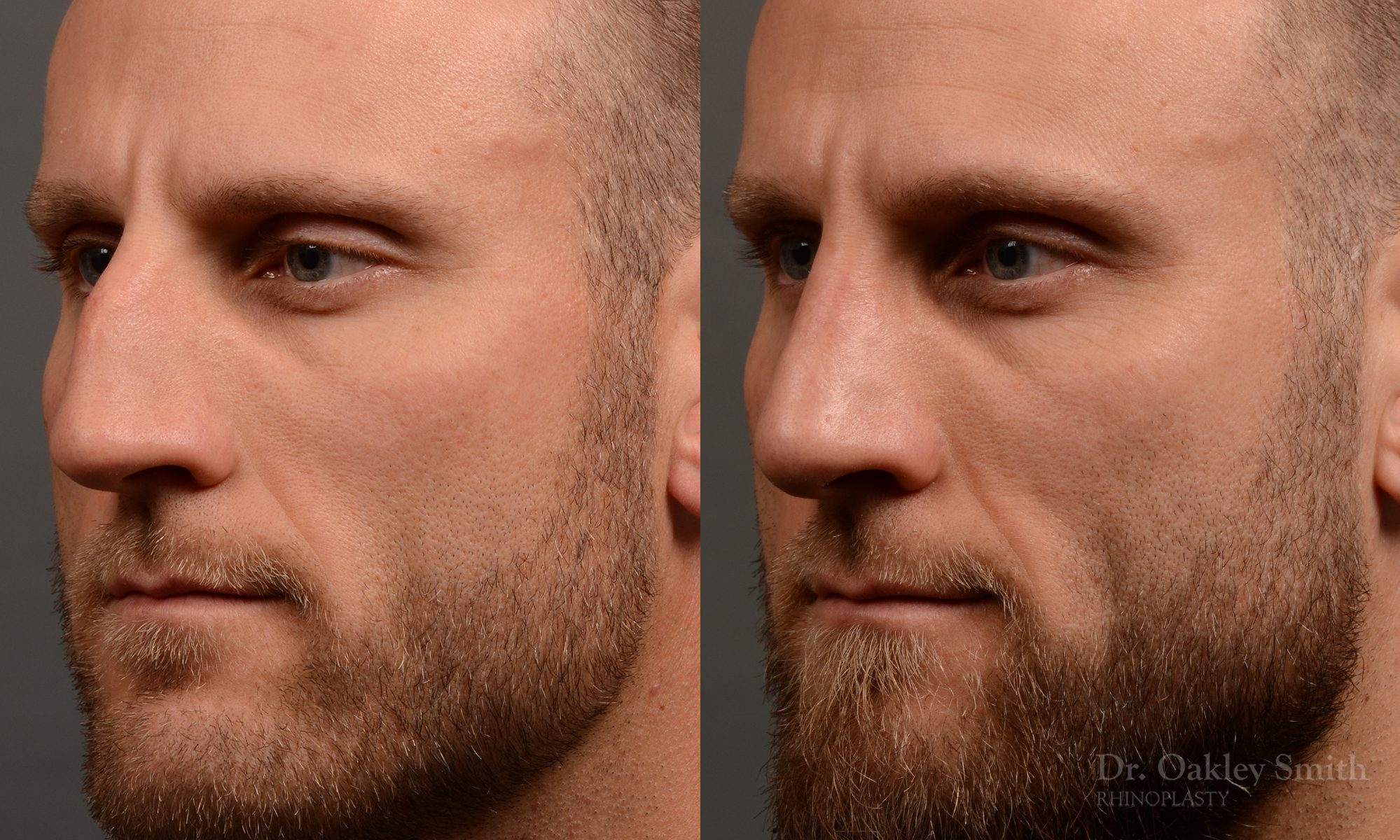 rhinoplasty Nothing demonstrates the skillful craftsmanship that Dr. Oakley Smith accomplishes during his surgeries than a collection of before and after case studies. As one of a hand full of surgeons in North America who limits his practice to only Rhinoplasty surgery, it is obvious that he has mastered his art. There is no question why he is one of the busiest cosmetic nose job surgeons in the country.