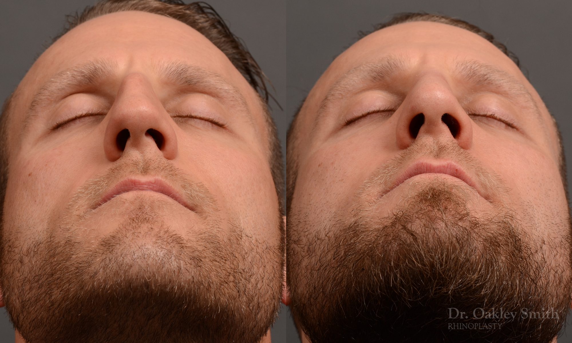 rhinoplasty Nothing demonstrates the skillful craftsmanship that Dr. Oakley Smith accomplishes during his surgeries than a collection of before and after case studies. As one of a hand full of surgeons in North America who limits his practice to only Rhinoplasty surgery, it is obvious that he has mastered his art. There is no question why he is one of the busiest cosmetic nose job surgeons in the country.