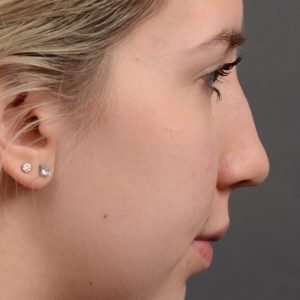 Nothing demonstrates the skillful craftsmanship that Dr. Oakley Smith accomplishes during his surgeries than a collection of before and after case studies. As one of a hand full of surgeons in North America who limits his practice to only Rhinoplasty surgery, it is obvious that he has mastered his art. There is no question why he is one of the busiest cosmetic nose job surgeons in the country.
