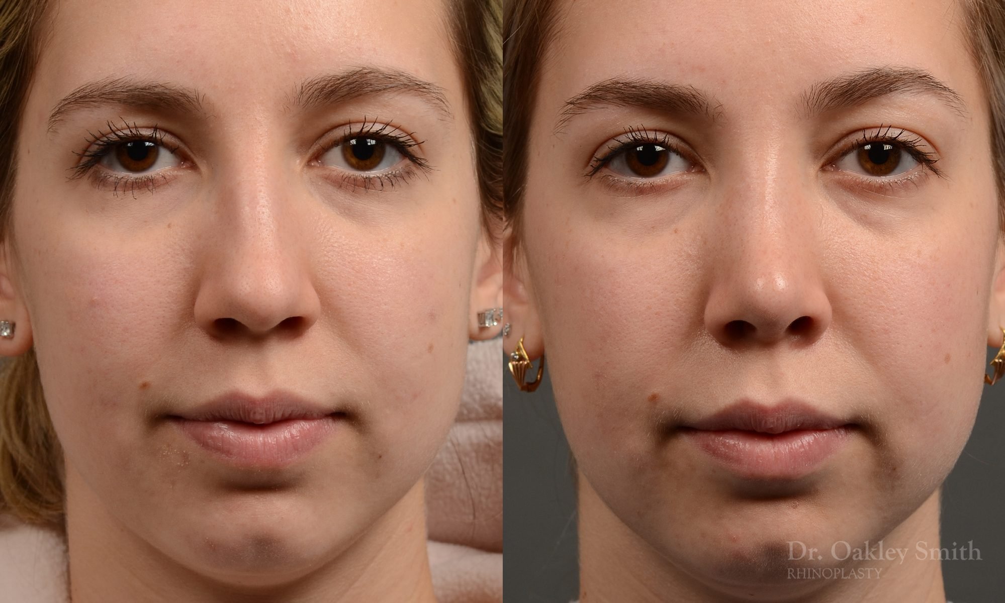 rhinoplasty Nothing demonstrates the skillful craftsmanship that Dr. Oakley Smith accomplishes during his surgeries than a collection of before and after case studies. As one of a hand full of surgeons in North America who limits his practice to only Rhinoplasty surgery, it is obvious that he has mastered his art. There is no question why he is one of the busiest cosmetic nose job surgeons in the country.