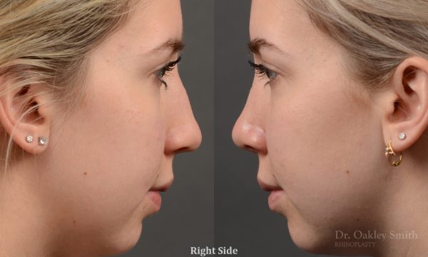 rhinoplasty Nothing demonstrates the skillful craftsmanship that Dr. Oakley Smith accomplishes during his surgeries than a collection of before and after case studies. As one of a hand full of surgeons in North America who limits his practice to only Rhinoplasty surgery, it is obvious that he has mastered his art. There is no question why he is one of the busiest cosmetic nose job surgeons in the country.