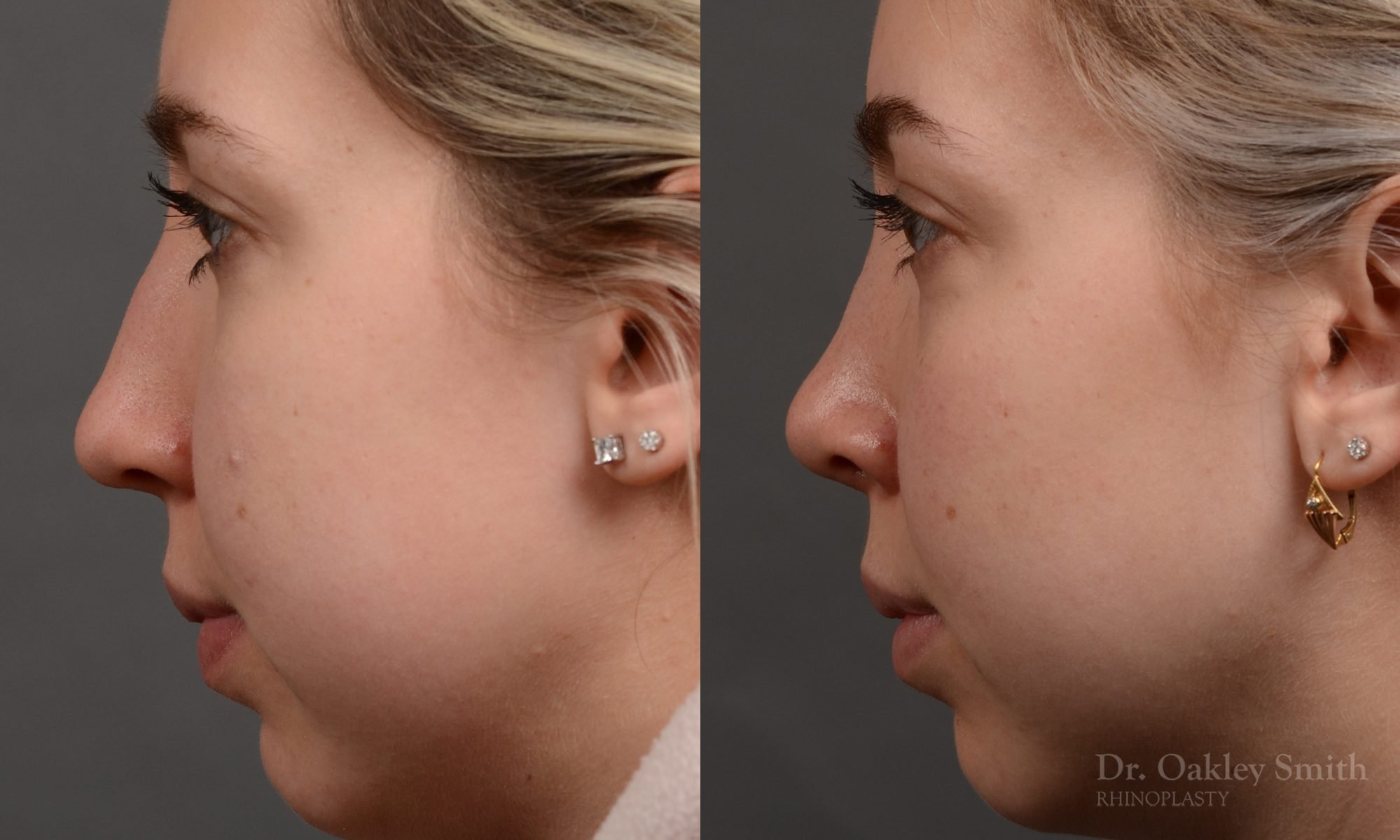 rhinoplasty Nothing demonstrates the skillful craftsmanship that Dr. Oakley Smith accomplishes during his surgeries than a collection of before and after case studies. As one of a hand full of surgeons in North America who limits his practice to only Rhinoplasty surgery, it is obvious that he has mastered his art. There is no question why he is one of the busiest cosmetic nose job surgeons in the country.