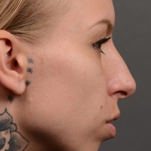 Nothing demonstrates the skillful craftsmanship that Dr. Oakley Smith accomplishes during his surgeries than a collection of before and after case studies. As one of a hand full of surgeons in North America who limits his practice to only Rhinoplasty surgery, it is obvious that he has mastered his art. There is no question why he is one of the busiest cosmetic nose job surgeons in the country.