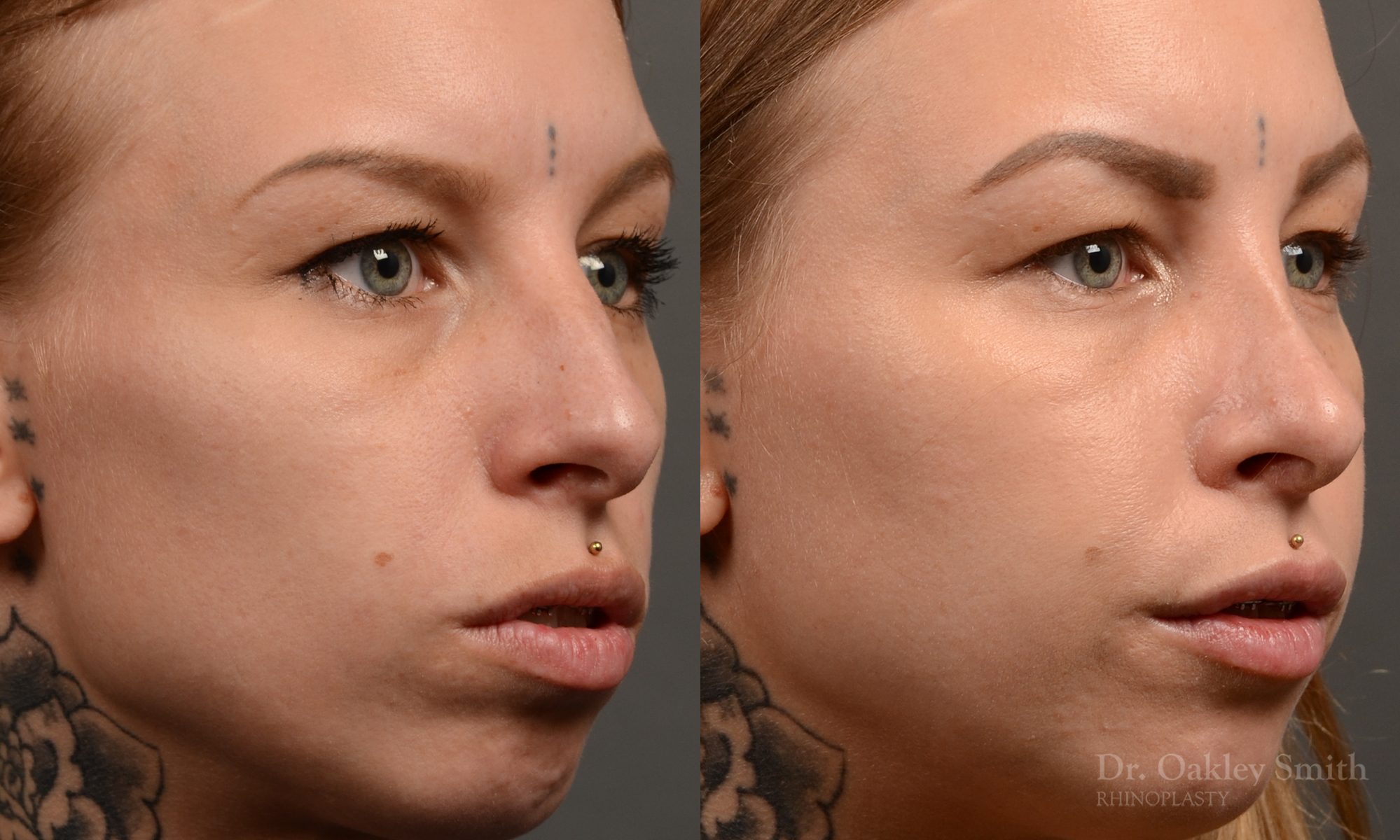 right third view rhinoplasty nose job