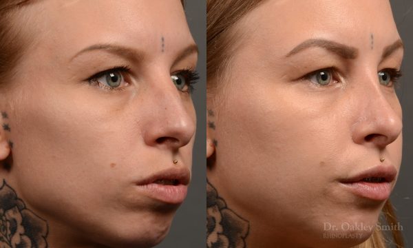 right third view rhinoplasty nose job