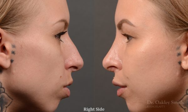 right profile side view rhinoplasty nose job